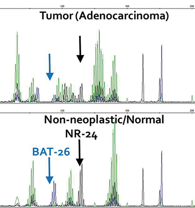 Fig. 2. (B) Microsatellite testing of the adenocarcinoma demonstrated instability of 5/5 mononucleotide repeats, two of which are highlighted here.