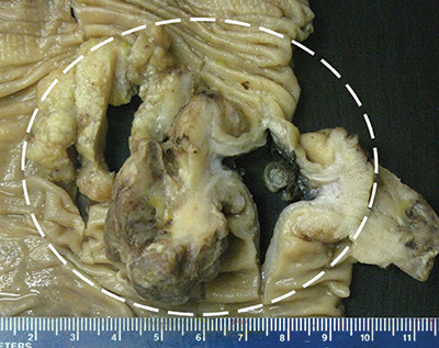 Fig. 1. Ileocolectomy specimen with (A) grossly identifiable fungating mass—outlined in white—extending into pericolic adipose tissue and centrally located firm, white area.