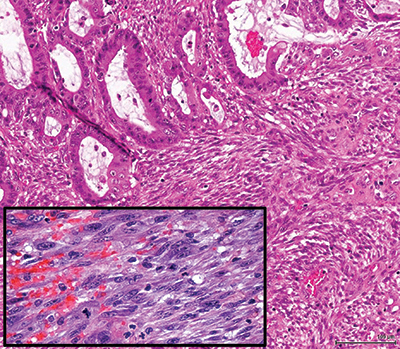 Fig. 1. (B) Microscopically, an adenocarcinoma interdigitates with a malignant spindle cell proliferation. Photomicrograph was taken at 200× (inset, 400×). 