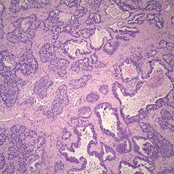 Fig. 1. Moderately differentiated adenocarcinoma, acinar predominant with peripheral lepidic growth.