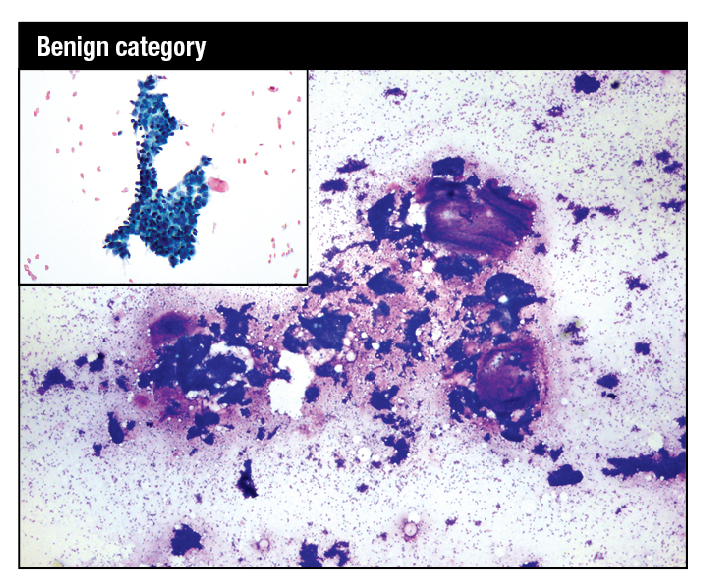 Modified Giemsa stain. Highly cellular smear showing fibroadenoma with mix of small and large hyperplastic ductal epithelial cell tissue fragments and large myxoid stromal fragments. High-power image shows myoepithelial nuclei on the epithelial fragments and in the background as bare bipolar nuclei. Inset: Modified Giemsa. Fragment of benign breast tissue consisting of ductal epithelial cells with interspersed myoepithelial cells.