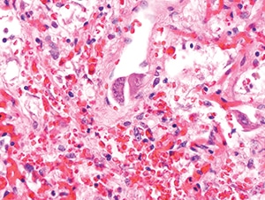 Figure 4.29. In this field from the same case as Figure 4.28, obvious viral cytopathic effect is present in endothelial cells with both nuclear and cytoplasmic inclusions (H&E, 400X).