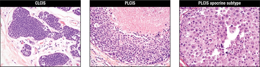 Fig. 20. From Chen YY, et al. Genetic and phenotypic characteristics of pleomorphic lobular carcinoma in situ of the breast. Am J Surg Pathol. 2009;33(11):1683–1694. 