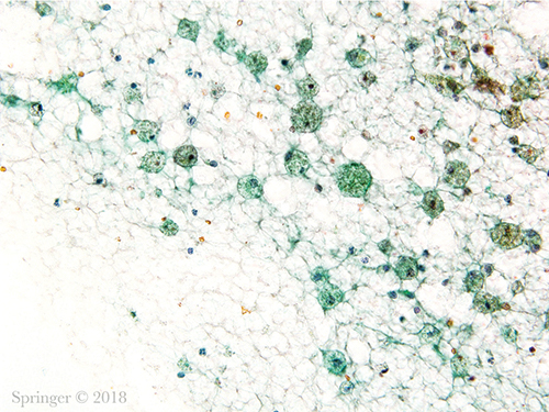Non-diagnostic. Non-mucinous cyst contents showing histiocytes, debris, and a few inflammatory cells (smear, Papanicolaou stain).
