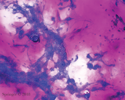 Pleomorphic adenoma. The stroma lacks the usual fibrillary character and mimics thick mucin (smear, Romanowsky stain).