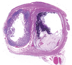 One challenge in the study was the classification of mucosal proliferations at the margin. This slide from the paper shows a case classified as dissecting mucin at the margin. The outside pathologists thought the epithelium lining the lumen of the appendix at the margin was neoplastic, while Dr. Misdraji and colleagues felt it was hyperplastic.