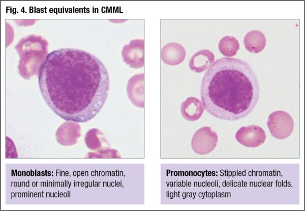 Peripheral blood evaluation: B12 deficiency, anemia, ET, CMML