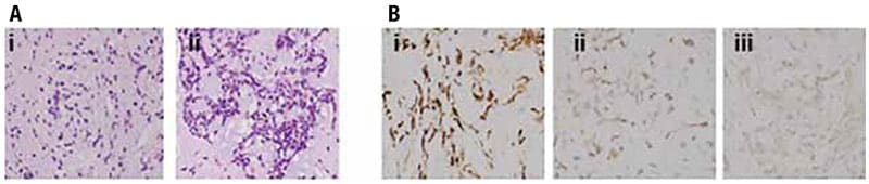 Histopathological and molecular analysis of the patient’s resected tumor