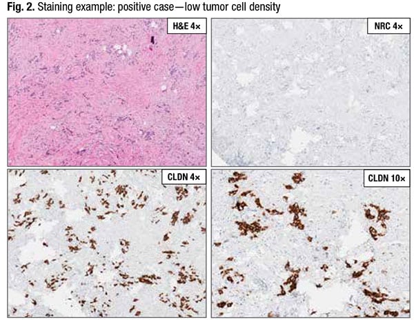 Fig. 2. Staining example: positive case — low tumor cell density