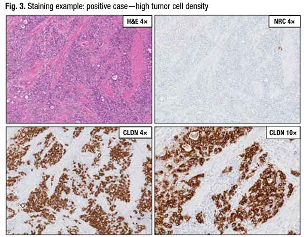 Fig. 3. Staining example: positive case — high tumor cell density