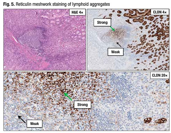 Fig. 5. Reticulin meshwork staining of lymphoid aggregates