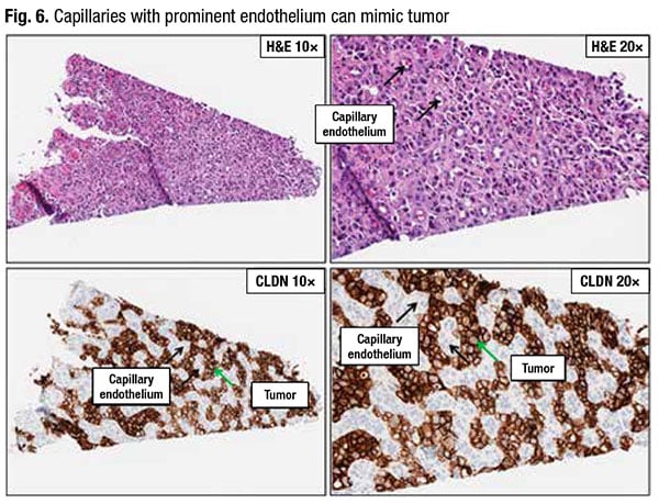 Fig. 6. Capillaries with prominent endothelium can mimic tumor