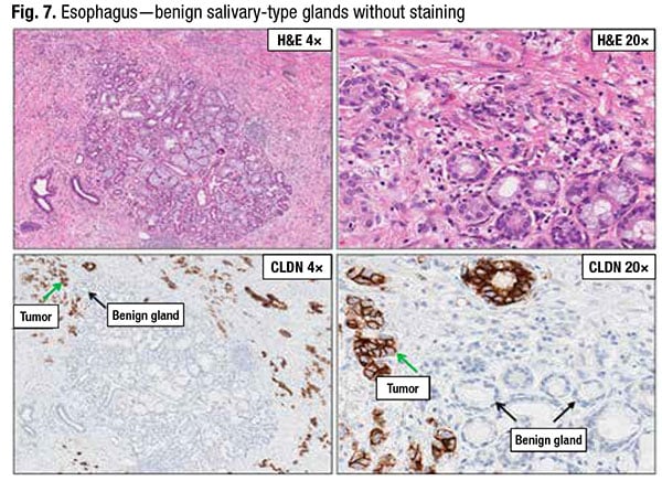 Fig. 7. Esophagus — benign salivary-type glands without staining