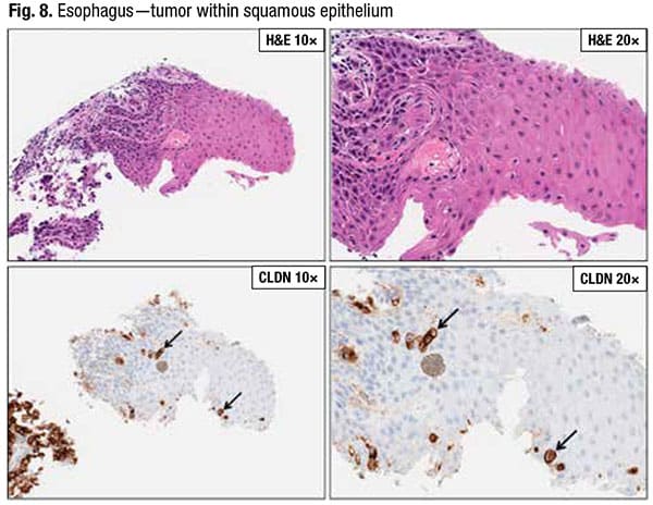 Fig. 8. Esophagus — tumor within squamous epithelium