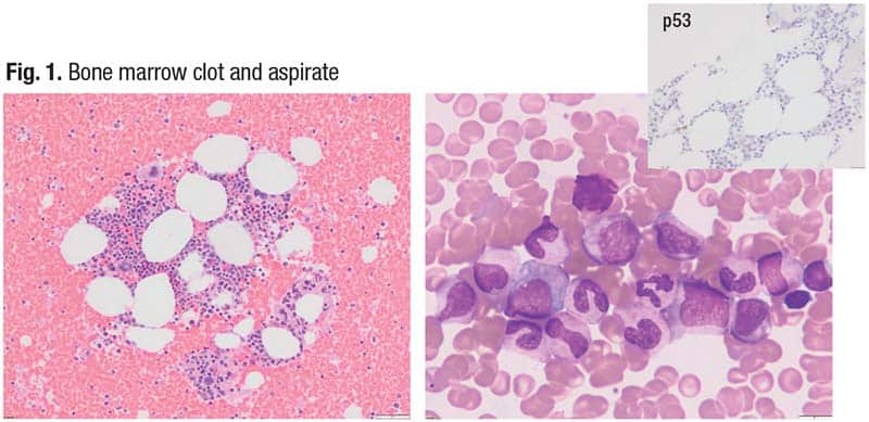 Fig. 1. Bone marrow clot and aspirate