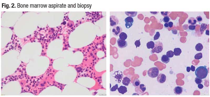 Fig. 2. Bone marrow aspirate and biopsy