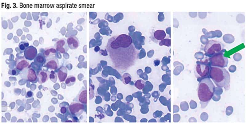 Fig. 3. Bone marrow aspirate smear