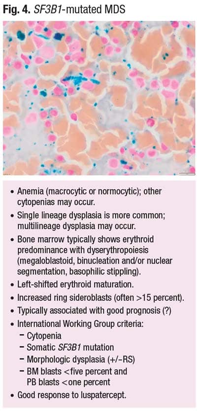Fig. 4. SF3B1-mutated MDS