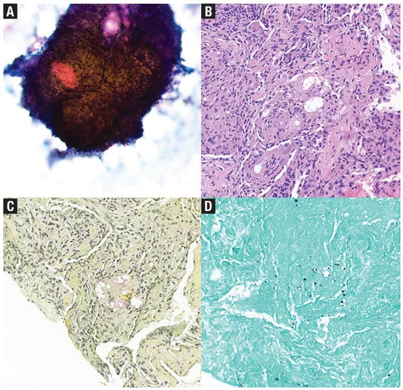 Infectious granulomatous inflammation.
