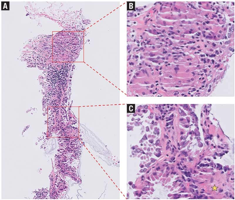 Granulomatous inflammation in a mucin-producing primary lung adenocarcinoma