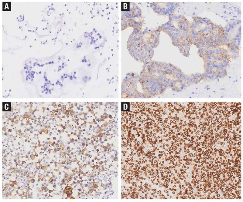 Interpretation of CLDN18.2 expression in cell blocks using immunohistochemistry. 