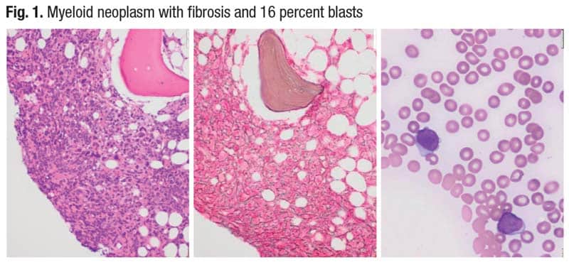 Myeloid neoplasm with fibrosis and 16 percent blasts