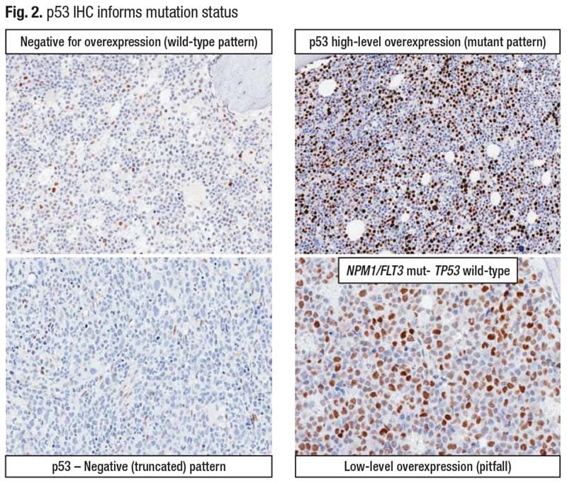p53 IHC informs mutation status