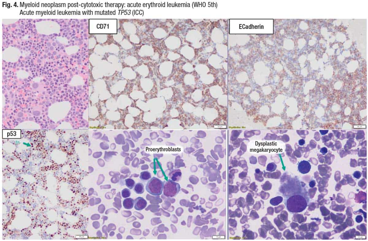 Myeloid neoplasm post-cytotoxic therapy: acute erythroid leukemia (WHO 5th). Acute myeloid leukemia with mutated TP53 (ICC)