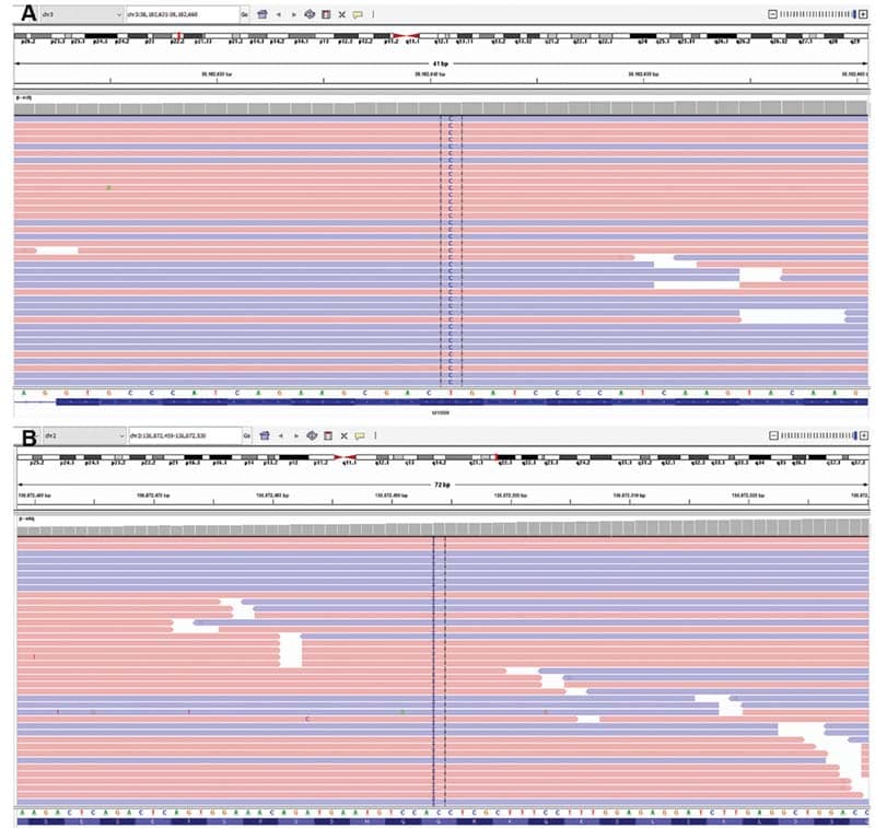 Integrative Genomics Viewer showing exon 5 of the MYD88 gene with sequencing reads 