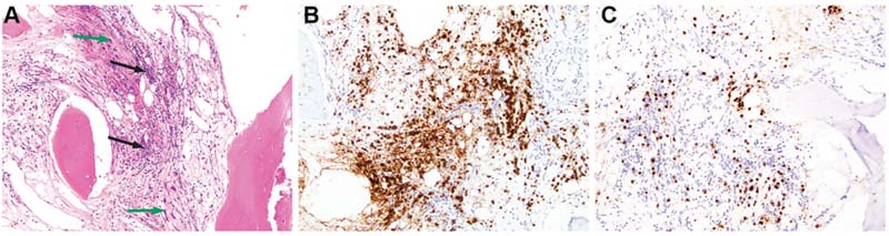 Hematoxylin and eosin stain of the sacrum biopsy