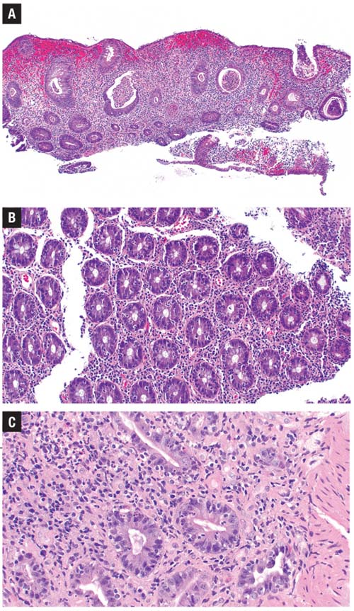 cases of PD-1 inhibitor colitis