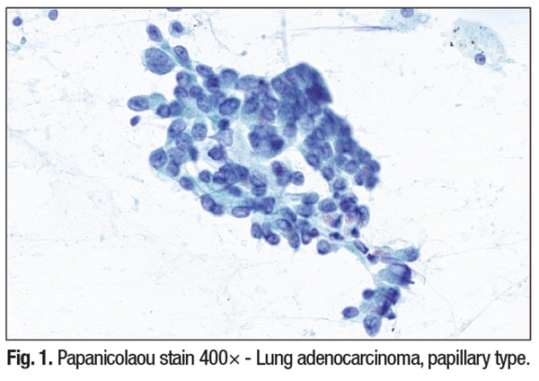 Fig. 1. Papanicolaou stain 400× - Lung adenocarcinoma, papillary type.