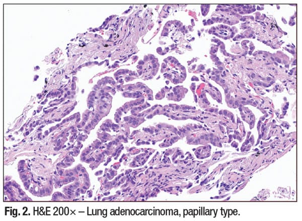 Fig. 2. H&E 200× – Lung adenocarcinoma, papillary type.