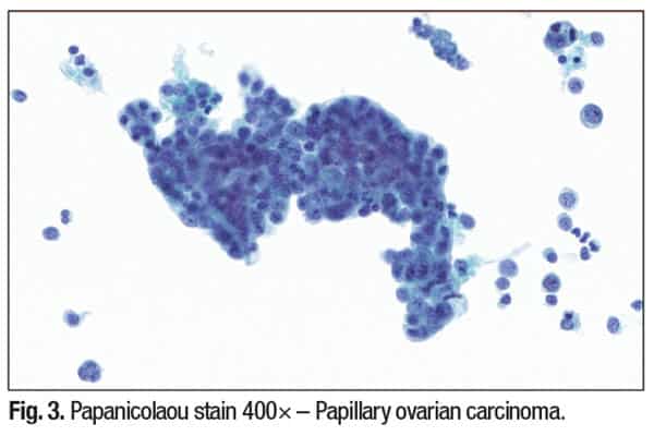 Fig. 3. Papanicolaou stain 400× – Papillary ovarian carcinoma.
