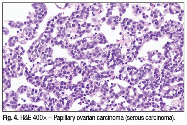 Fig. 4. H&E 400× – Papillary ovarian carcinoma (serous carcinoma).