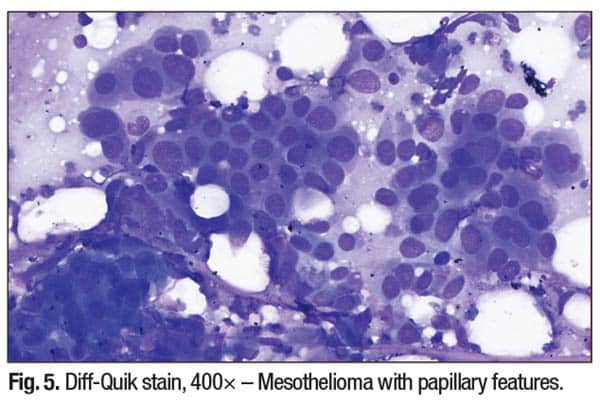 Fig. 5. Diff-Quik stain, 400× – Mesothelioma with papillary features.