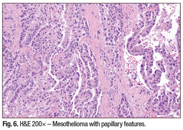Fig. 6. H&E 200× – Mesothelioma with papillary features.