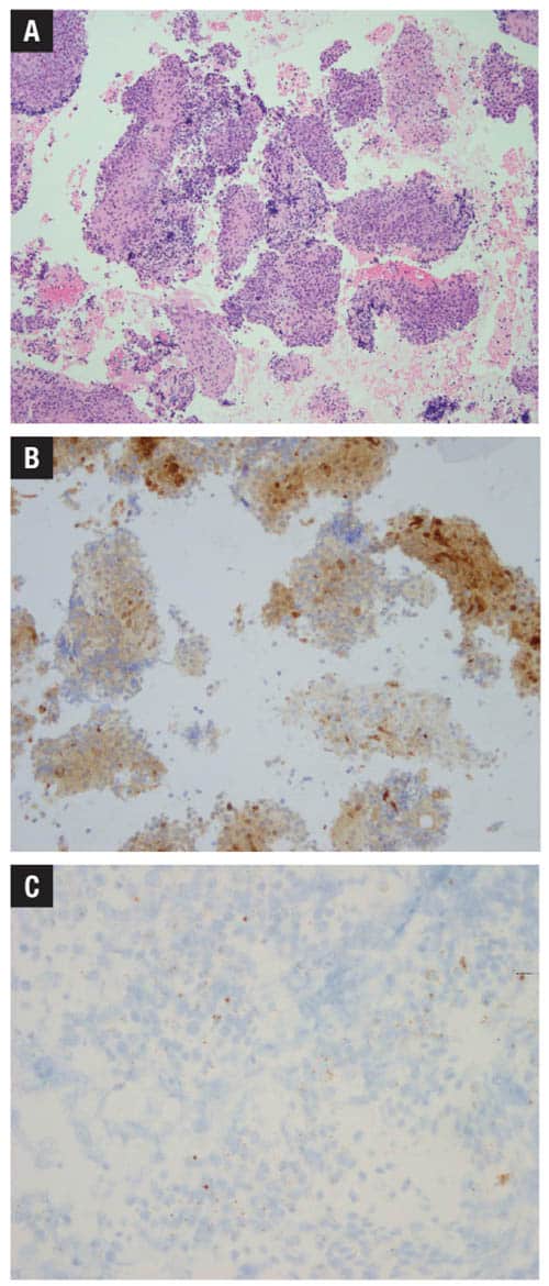 Fig. 1. A) Cervical lymph node cell block H&E 