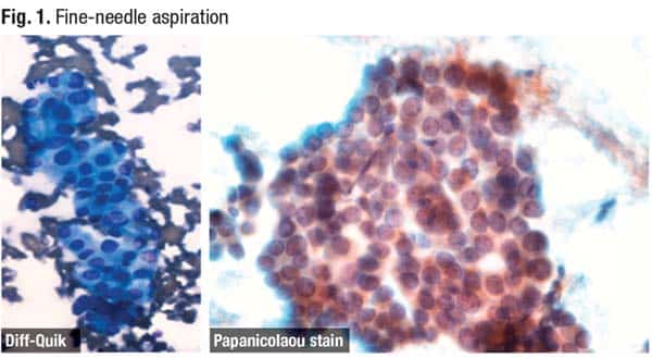 Fig. 1. Fine-needle aspiration