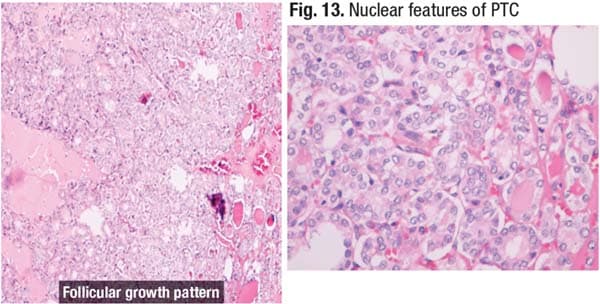 Fig. 13. Nuclear features of PTC