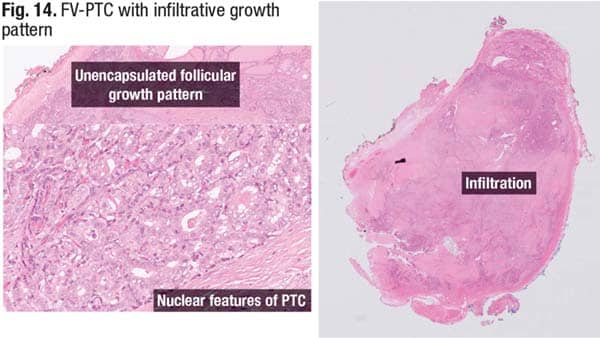 Fig. 14. FV-PTC with infiltrative growth pattern