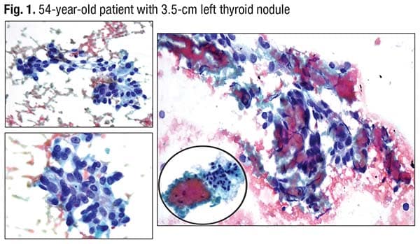 Fig. 1. 54-year-old patient with 3.5-cm left thyroid nodule