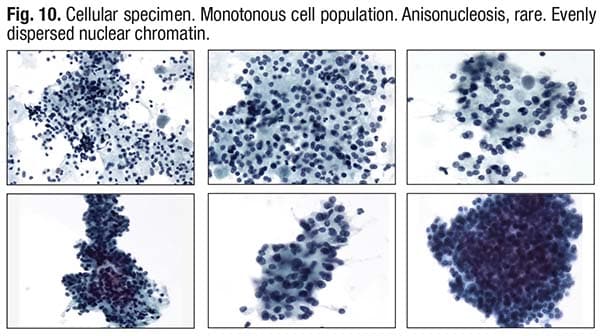 Fig. 10. Cellular specimen. Monotonous cell population. Anisonucleosis, rare. Evenly dispersed nuclear chromatin.