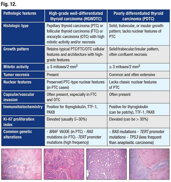 Fig. 12. criteria for poorly differentiated thyroid carcinoma and differentiated high-grade thyroid carcinoma