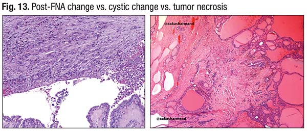 Fig. 13. Post-FNA change vs. cystic change vs. tumor necrosis