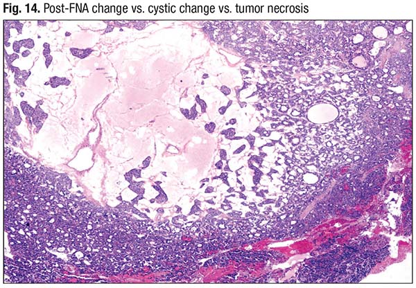 Fig. 14. Post-FNA change vs. cystic change vs. tumor necrosis