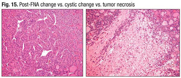 Fig. 15. Post-FNA change vs. cystic change vs. tumor necrosis