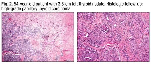 Fig. 2. 54-year-old patient with 3.5-cm left thyroid nodule. Histologic follow-up: high-grade papillary thyroid carcinoma