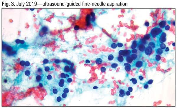 Fig. 3. July 2019—ultrasound-guided fine-needle aspiration