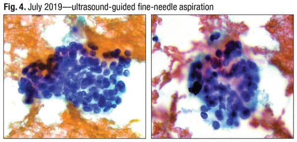Fig. 4. July 2019—ultrasound-guided fine-needle aspiration
